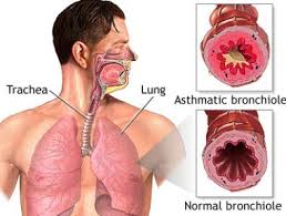 ramuan obat herbal penyakit bronkitis